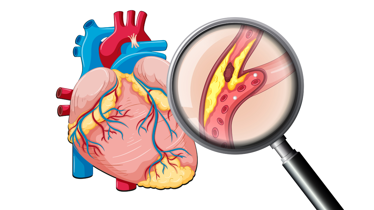 Myocardial Infarction