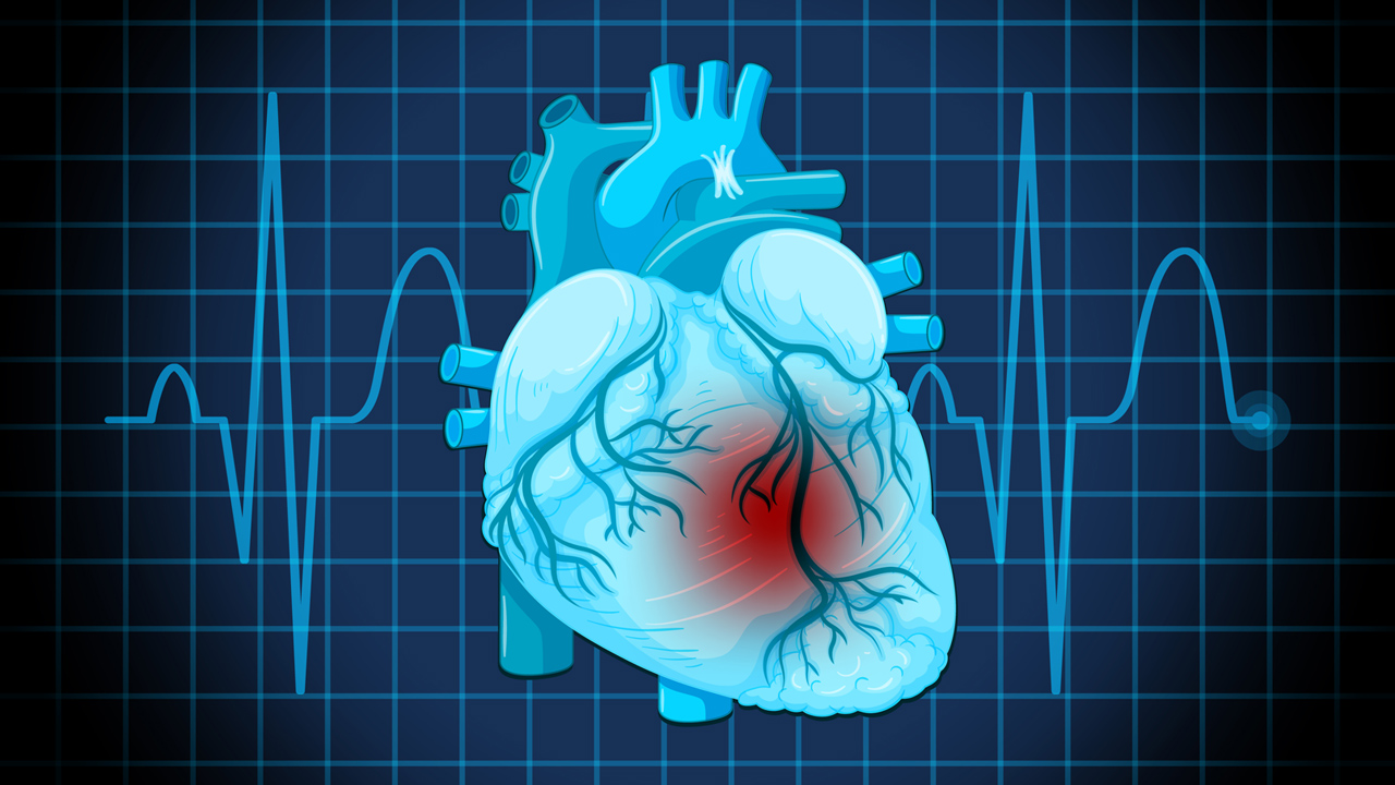 Pathology of Myocardial Infarction