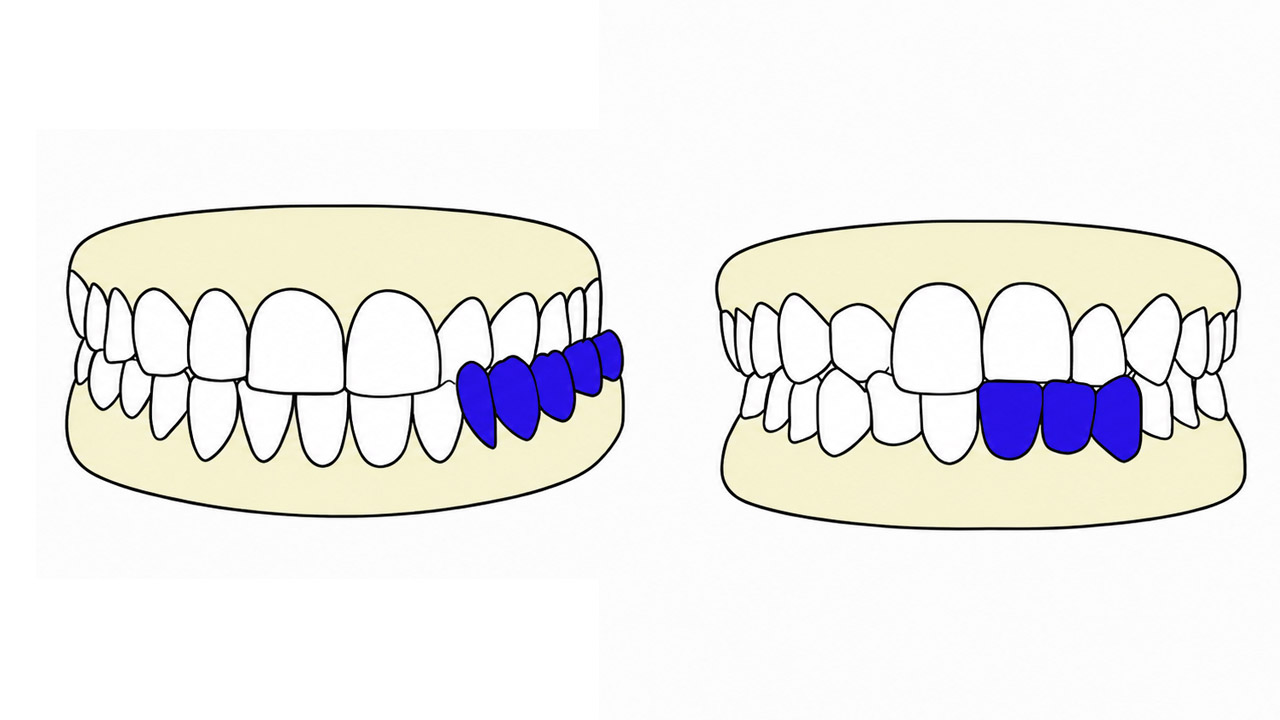 Cross Bite in Orthodontics