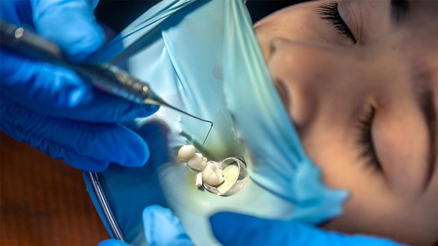 Class II Amalgam Restorations
