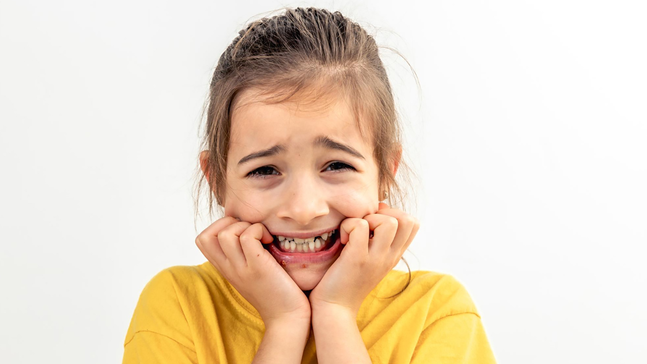 Class III Malocclusion
